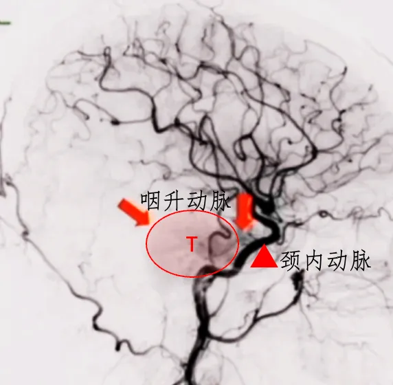 該腫瘤周圍環(huán)繞有豐富的血管結(jié)構(gòu)，主要包括咽升動脈以及頸內(nèi)動脈硬腦膜分支。在手術(shù)過程中，這些血管容易受到損傷，從而導致出血。