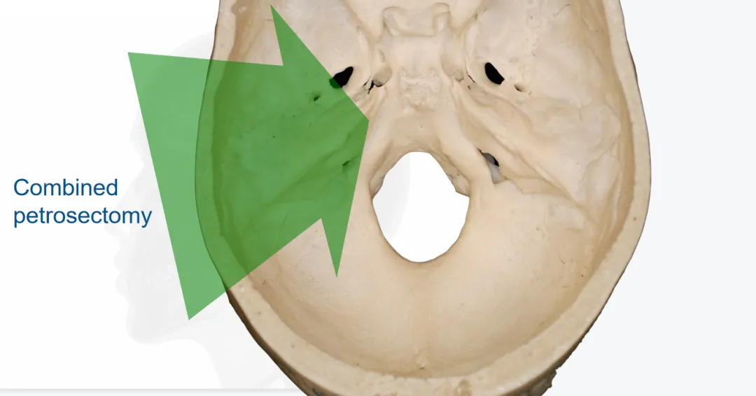 《How I do it: combined petrosectomy》（我是如何操作的：聯(lián)合巖骨切除術(shù)）