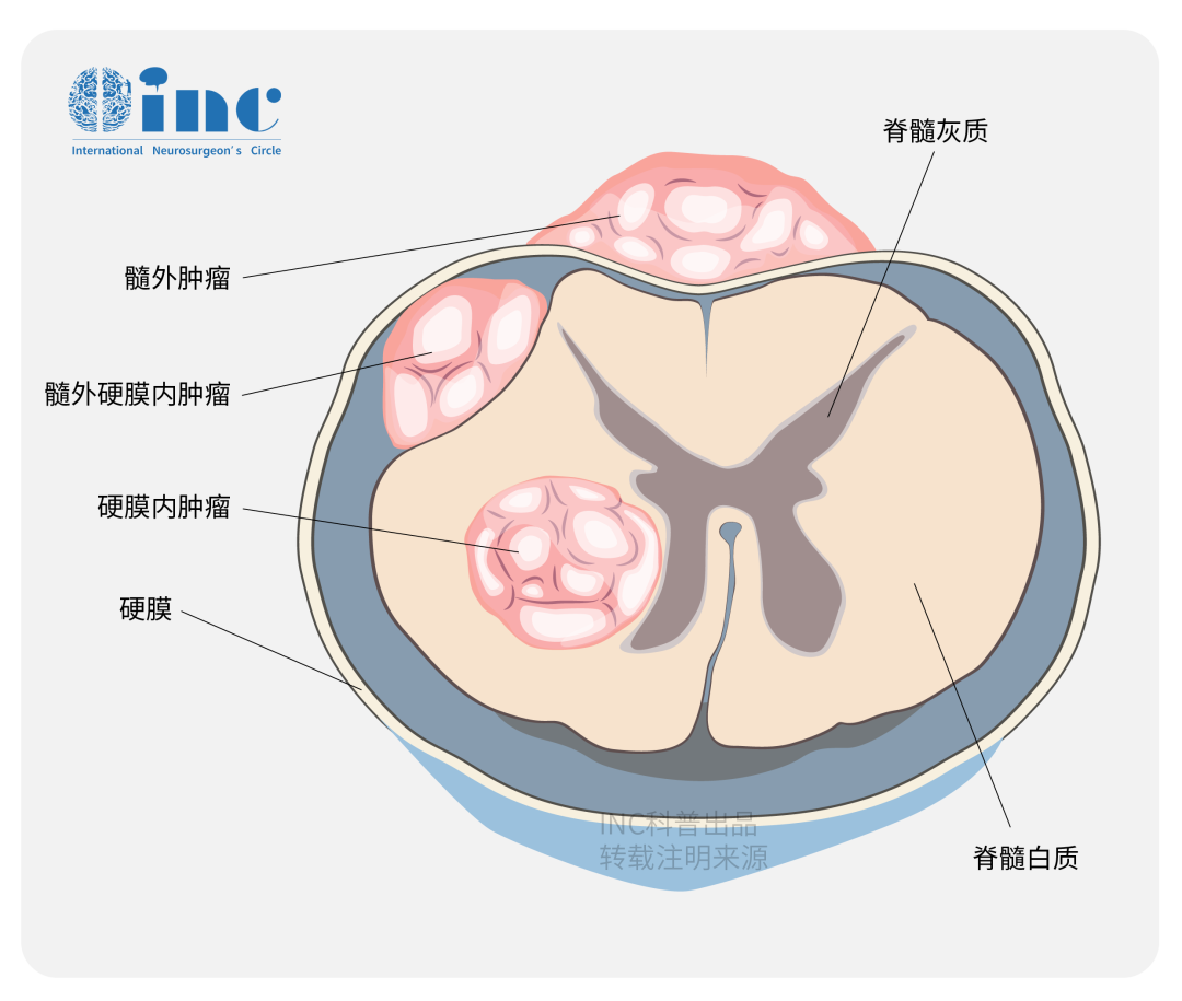 脊柱腫瘤可以從椎骨開始（硬膜外腫瘤），也可以位于腦膜內(nèi)（硬膜內(nèi)腫瘤）。硬膜內(nèi)腫瘤可分為脊髓腫瘤（髓內(nèi)腫瘤）和不起源于脊髓的髓外腫瘤。