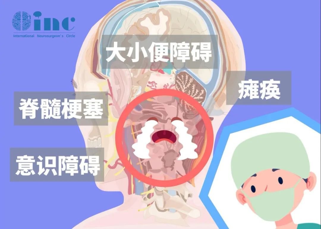 脊髓腫瘤常見癥狀
