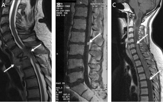 圖1：脊柱腫瘤的 MRI 圖像(箭頭)A，第三胸椎水平的腎癌椎體轉(zhuǎn)移，脊髓受到嚴重壓迫;B，硬膜內(nèi)上皮瘤;C，C5 - T4廣泛髓內(nèi)上皮瘤。