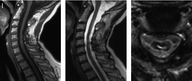 圖7I：手術 4 年后的 MRI 圖像顯示腫瘤已完全切除。除左手精細運動障礙外，患者無其他不適。