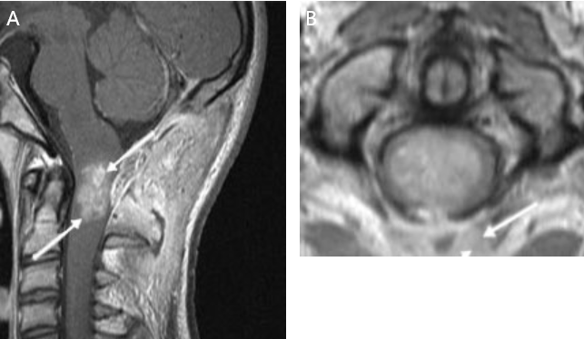 圖8：A，MRI（箭頭）。B，箭頭所指為腫瘤周圍剩余的正常脊髓組織（蒼白腫瘤周圍的灰色邊緣）。