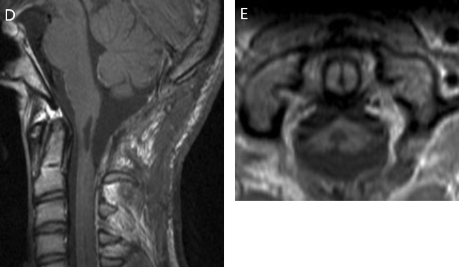 圖8D&E：術后 3 個月的隨訪 MRI 顯示腫瘤已完全切除。除了右手有輕微的笨拙外，患者的神經(jīng)功能正常。