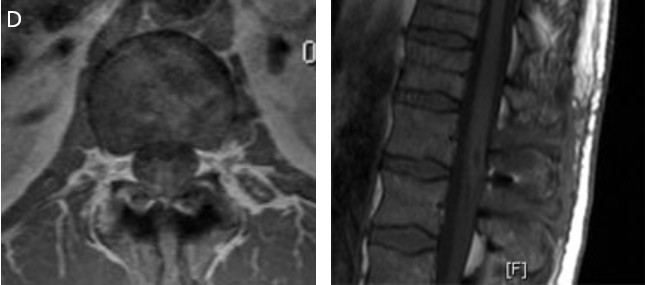 圖10D：手術 3 個月后的隨訪 MRI 顯示腫瘤已完全切除，囊腫已塌陷，障礙完全消除。