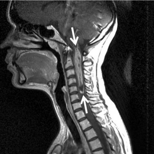 圖11：患者術前MRI。