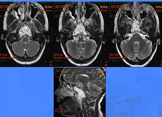圖示為患者術(shù)后進(jìn)行的磁共振成像（MRI）掃描，高信號區(qū)域代表脂肪組織。福教授認(rèn)為，采用內(nèi)鏡技術(shù)抵達(dá)顱頸交界區(qū)更為簡便。