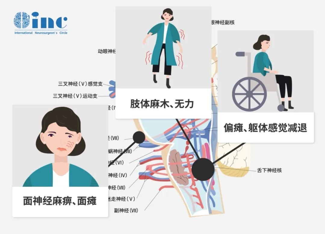 神經(jīng)功能損傷