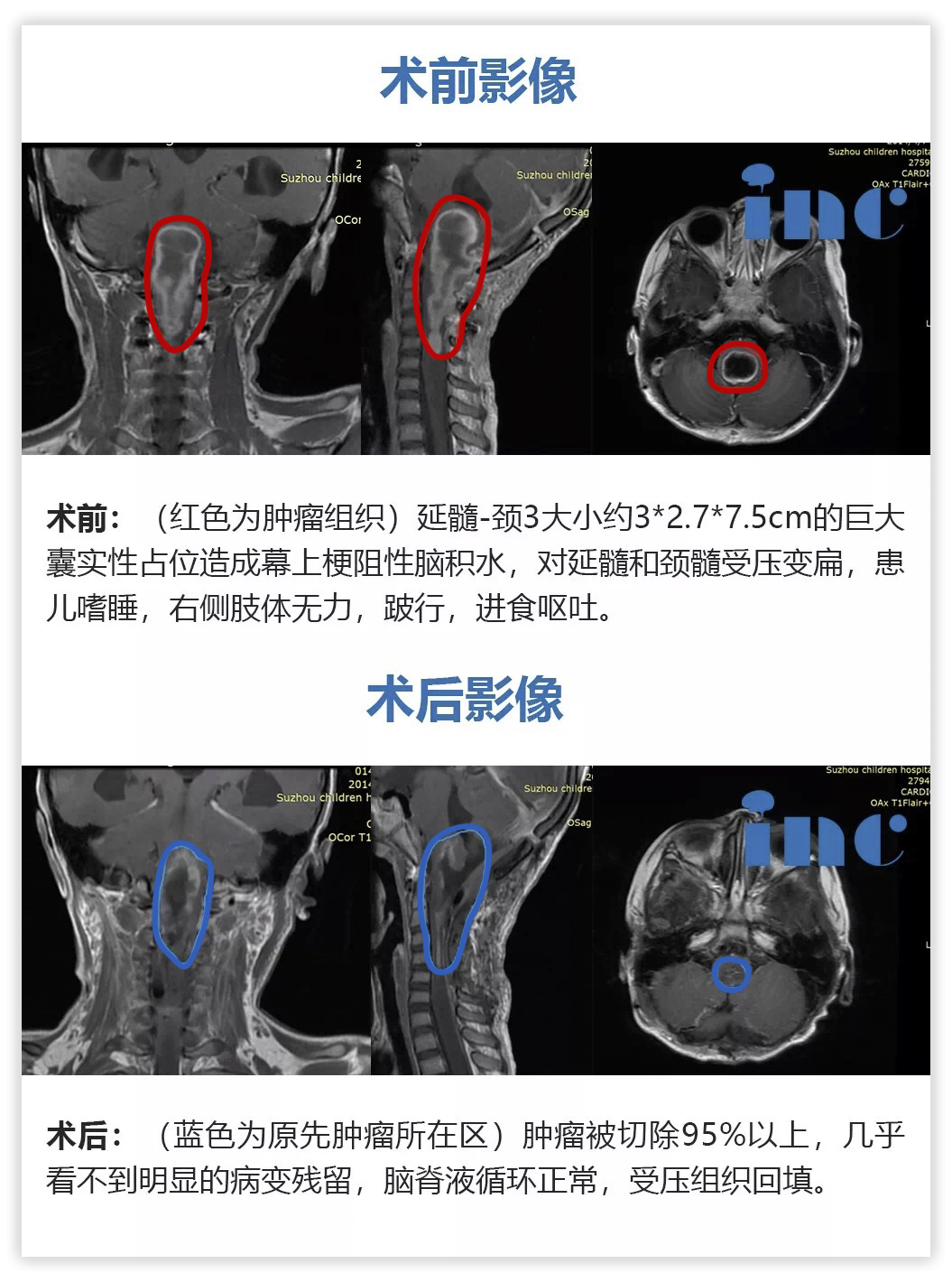 6歲女孩——脊髓-腦干毛細(xì)胞星形細(xì)胞瘤