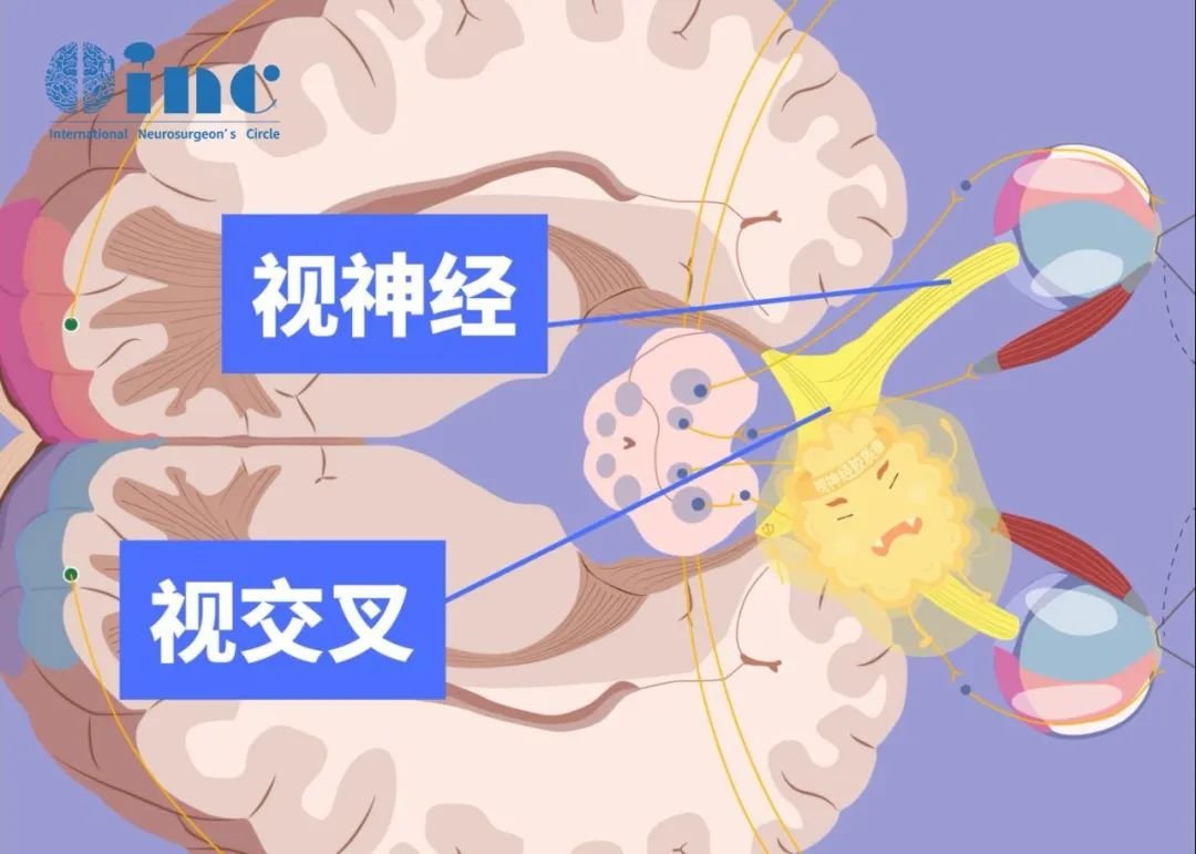 毛細(xì)胞粘液樣型星形細(xì)胞瘤多發(fā)生于下丘腦和視神經(jīng)（視神經(jīng)等），癥狀包括早熟、嘔吐和視力不佳等。具有播種的特性，生長速度快，所以發(fā)現(xiàn)病變應(yīng)盡早治療。