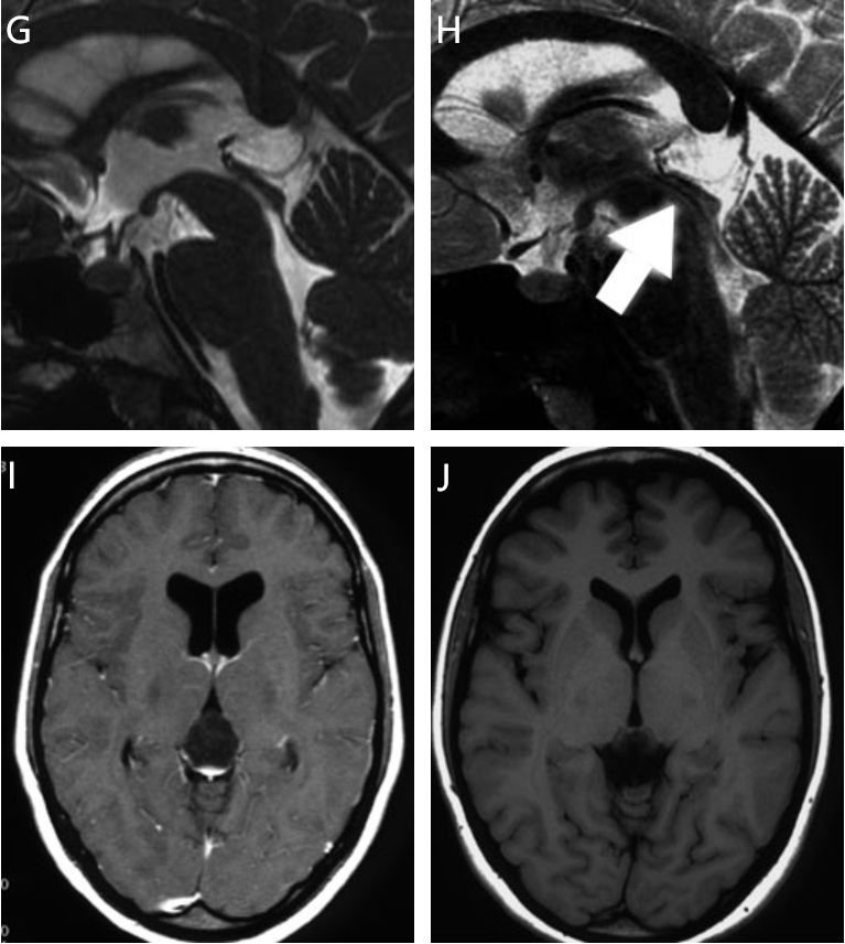 圖2：C，囊腫的內(nèi)窺鏡視圖。D，用腱膜鉗打開囊腫。E，囊腫切開后，囊腫塌陷，導(dǎo)水管被打開（箭頭）。F，囊腫內(nèi)的松果體組織。