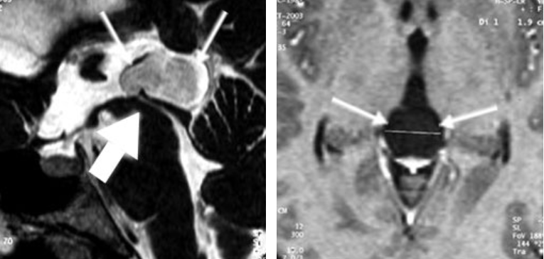 圖6：松果體囊腫的 MRI(矢狀切面和軸切面)。可以看到導(dǎo)水管(粗箭頭)被囊腫(細箭頭)移位。