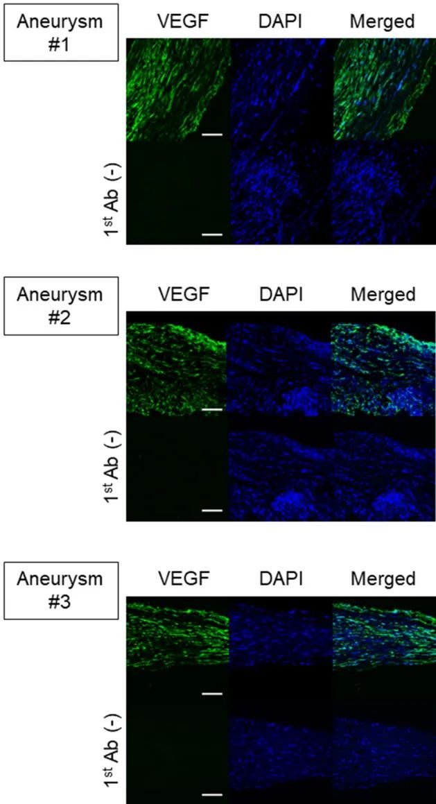 圖3：VEGF 在人類未破裂顱內(nèi)動(dòng)脈瘤中的表達(dá)。顯示了 VEGF (綠色) 、 DAPI 核染色 (藍(lán)色) 和合并圖像的腦動(dòng)脈瘤病灶免疫熒光染色的圖像。