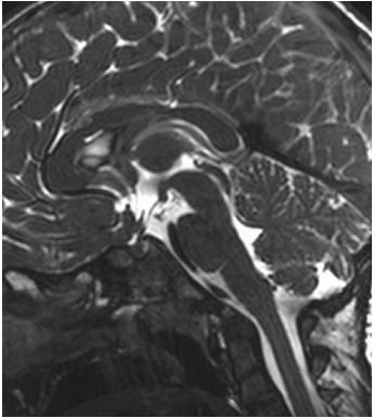 術(shù)后MRI