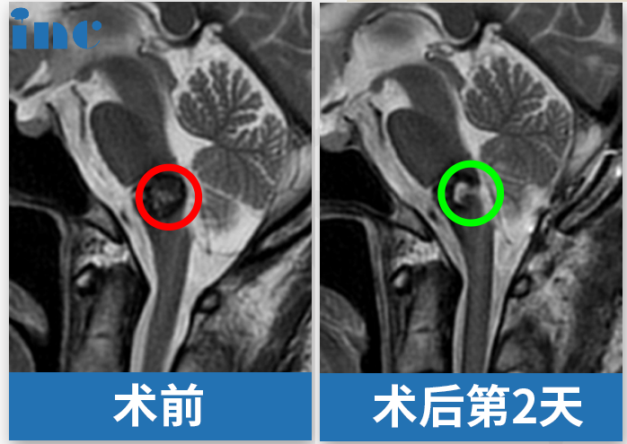 50歲女性延髓海綿狀血管瘤