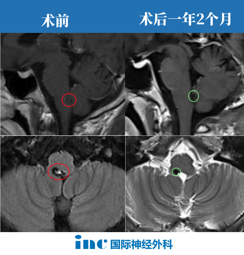 21歲男性-延髓海綿狀血管瘤