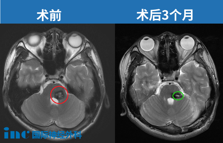 14歲男孩-橋腦海綿狀血管瘤