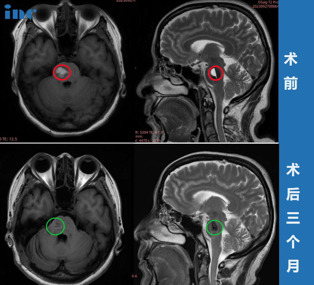 52歲女性-橋腦海綿狀血管瘤