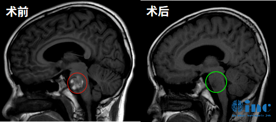 12歲男孩-橋腦海綿狀血管瘤