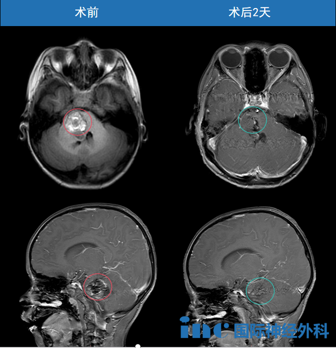 5歲男孩中腦海綿狀血管瘤