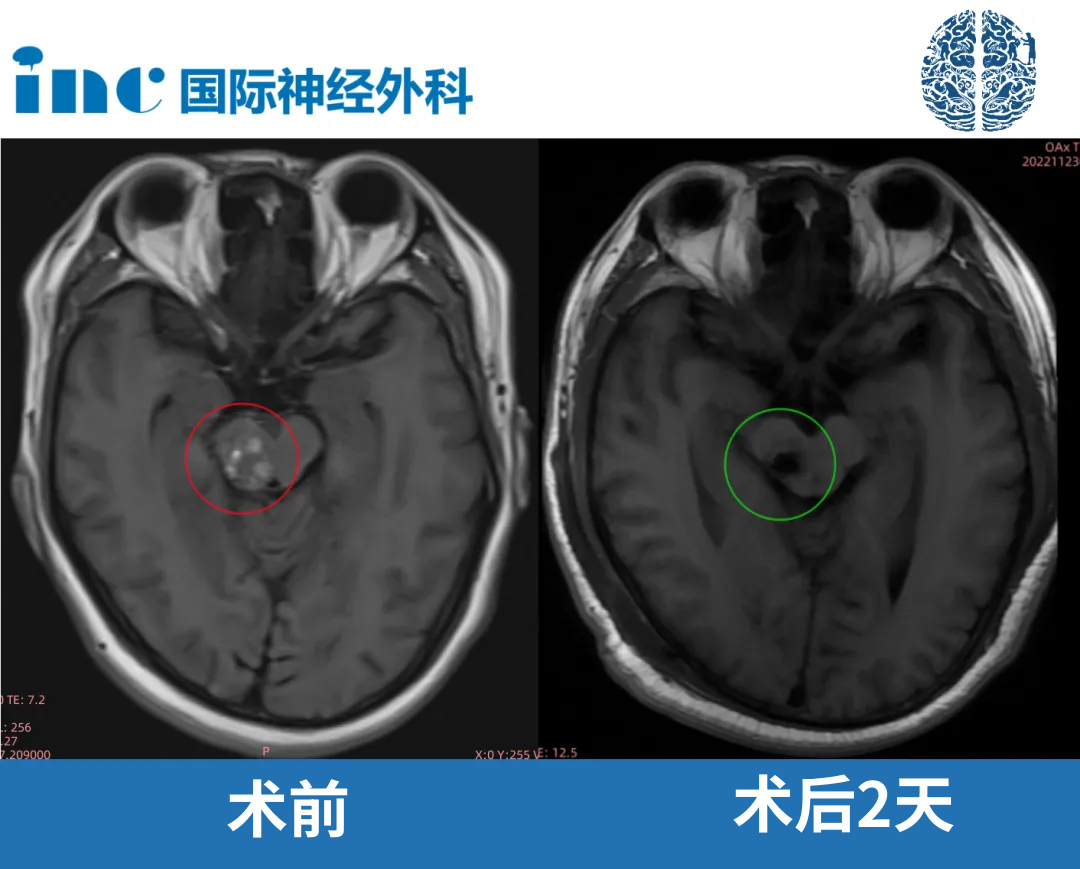 47歲男性中腦海綿狀血管瘤