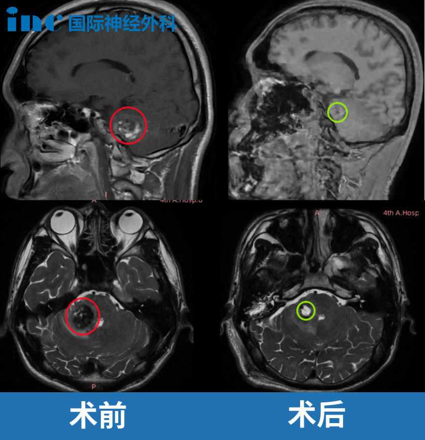 18歲男孩中腦海綿狀血管瘤