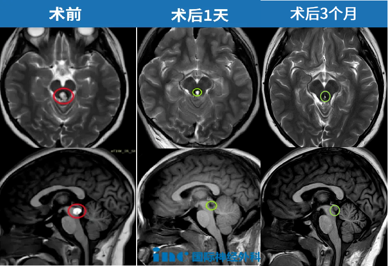 11歲女孩中腦海綿狀血管瘤