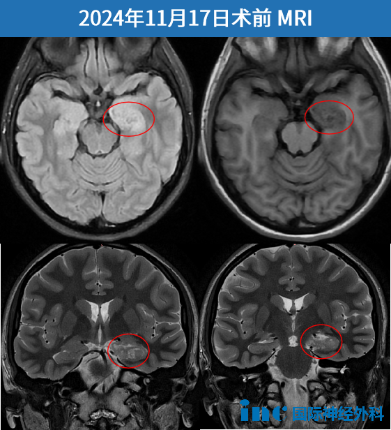 術前MRI