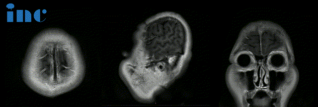 術前MRI：腫瘤體積巨大，廣泛累及顱底結構，侵蝕斜坡、鞍內鞍上、海綿竇區(qū)，包裹右側頸內動脈。腫瘤向上推擠視神經(jīng)、視交叉，到達三腦室底部；向后上方推擠腦干和基底動脈，部分腫瘤邊緣與腦干分界欠清。