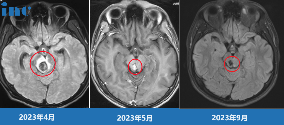 雖然出血已經(jīng)在吸收，但血管畸形仍在原地