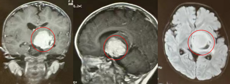 面對多數(shù)兒童腦腫瘤，手術(shù)往往是能夠徹底清除病灶、為孩子贏得生存希望的治療手段。