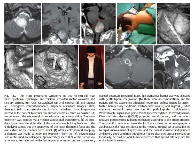 《adult brainstem glioma》（成人腦干膠質瘤）