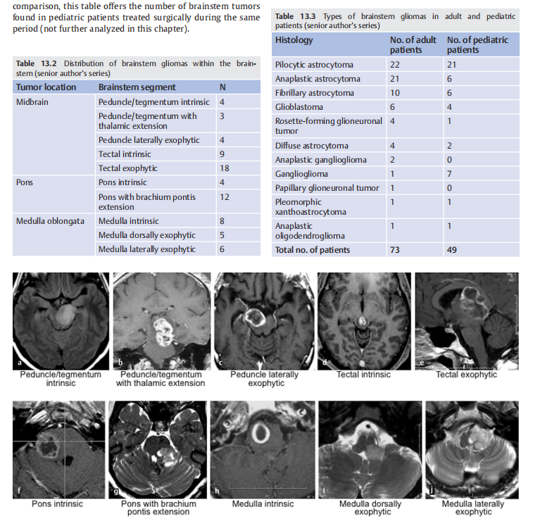 《adult brainstem glioma》（成人腦干膠質瘤）