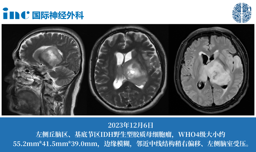 61歲男性左側丘腦-基底節(jié)-顳葉膠質瘤
