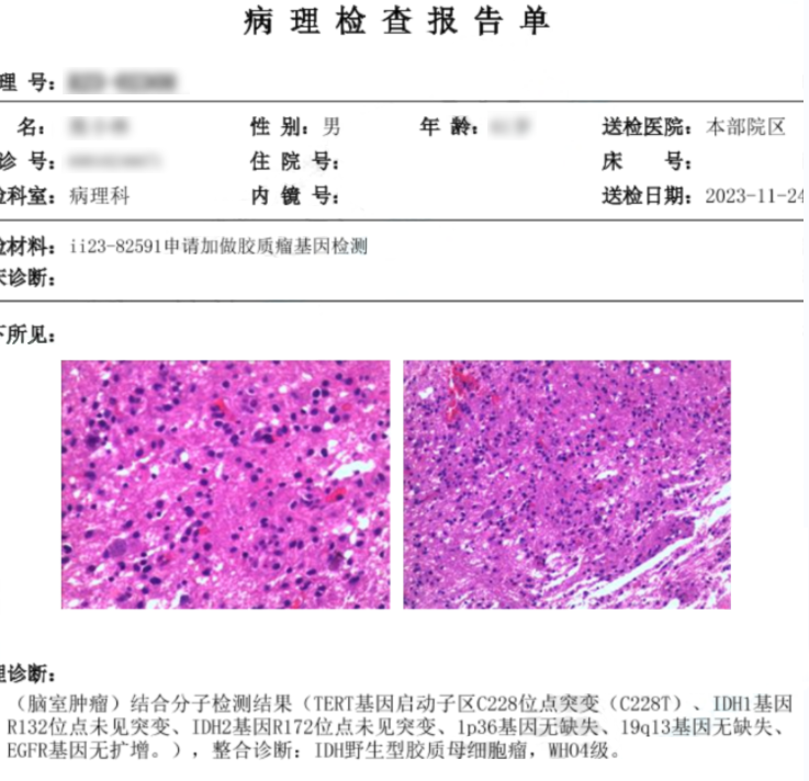 61歲男性左側丘腦-基底節(jié)-顳葉膠質瘤