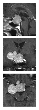 磁共振成像(MRI)檢查揭示了一個位于右側(cè)、緊靠垂體區(qū)域的大型垂體腺瘤，并且該腫瘤在注射對比劑后呈現(xiàn)吸收現(xiàn)象。