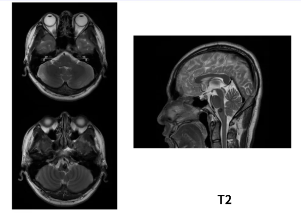 術(shù)前MRI