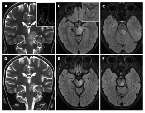 (病毒性腦炎患者，橫斷位T2WI FLAIR示延髓區(qū)域異常高信號)