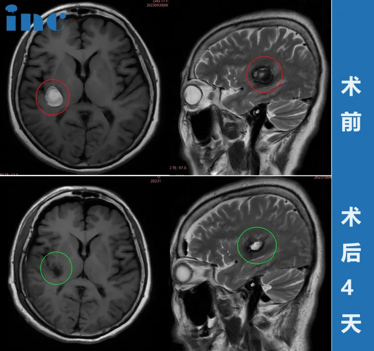 術(shù)前術(shù)后MRI影像