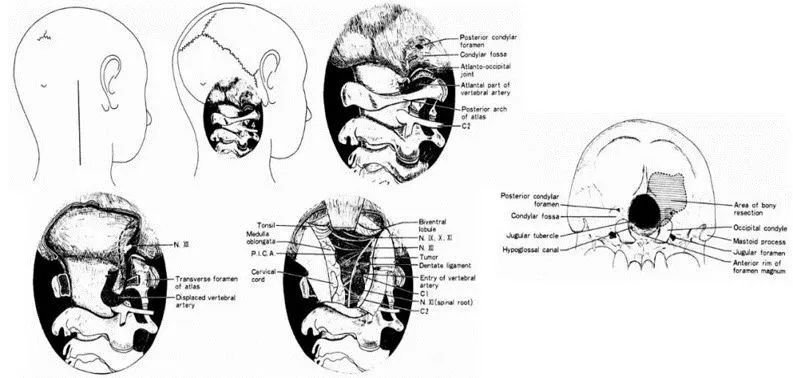 圖:Bertalanffy和其導(dǎo)師Seeger(1991)提出的“dorsolateral,suboccipital,transcondylar approach”入路