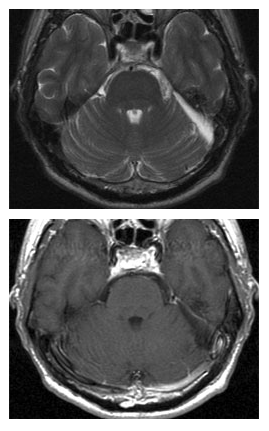術(shù)后 MRI 圖像顯示腫瘤已完全切除。
