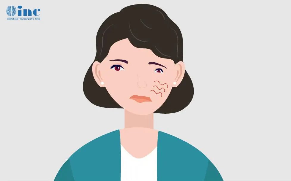 如果患者面神經(jīng)的顱內(nèi)段或顳骨段受到損傷，如：乳突區(qū)的病變累及面神經(jīng)垂直段，同時(shí)面神經(jīng)遠(yuǎn)端良好，可以采取面神經(jīng)遠(yuǎn)端與其鄰近的顱神經(jīng)吻合，如：舌下神經(jīng)或副神經(jīng)等。