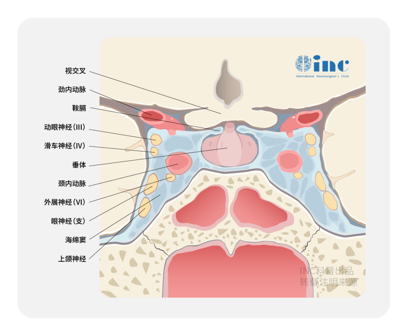 INC國(guó)際三大教授關(guān)于海綿竇腦膜瘤開顱內(nèi)鏡手術(shù)進(jìn)展