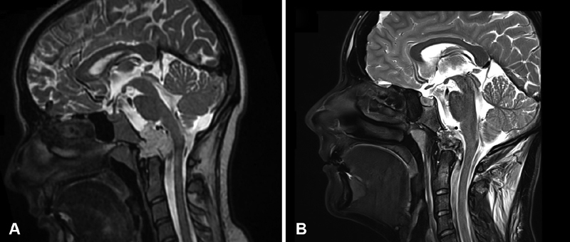 圖1，術前和術后磁共振成像(MRI)。(A)術前矢狀面t2加權MRI顯示以顱頸交界區(qū)為中心的高信號病變（脊索瘤），伴有硬膜內延伸和神經血管結構受壓。(B) 術后矢狀 T2 加權 MRI 顯示腫瘤實現了全切。