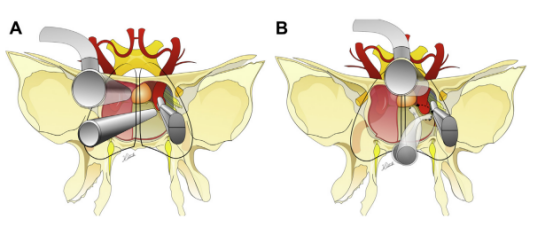(A) Binostril 和 (B) 使用有角度器械的單鼻孔入路。旋轉(zhuǎn)軸與吸力角度相結(jié)合，導(dǎo)致手指的小動作在曝光深度上被放大，并允許 360 度范圍。當(dāng)用拇指和中指和無名指控制時，吸力還可以沿前后方向移動。