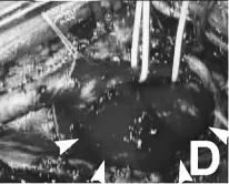 D：術(shù)中照片顯示頸動(dòng)脈內(nèi)膜切除術(shù)中暴露的頸動(dòng)脈分叉遠(yuǎn)端的梭狀動(dòng)脈瘤(箭頭)。