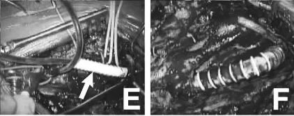 E&F：分流管通過(guò)血管假體(雙直徑5mm，長(zhǎng)度6cm)(箭頭)，連接頸總動(dòng)脈(CCA)和遠(yuǎn)端ICA，并用血管假體進(jìn)行切除重建。