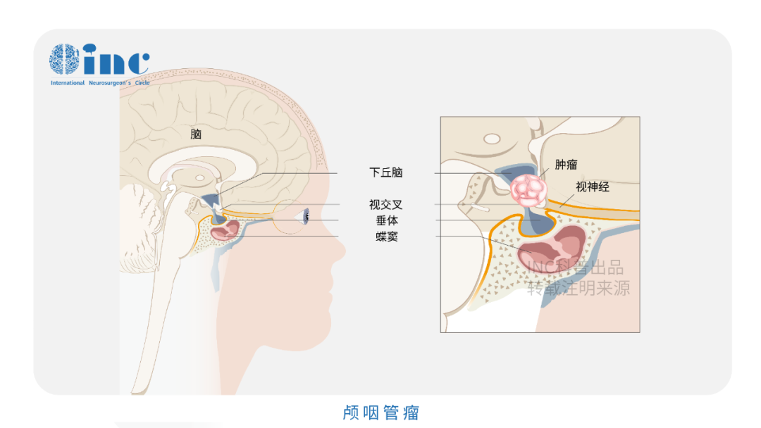 顱咽管瘤