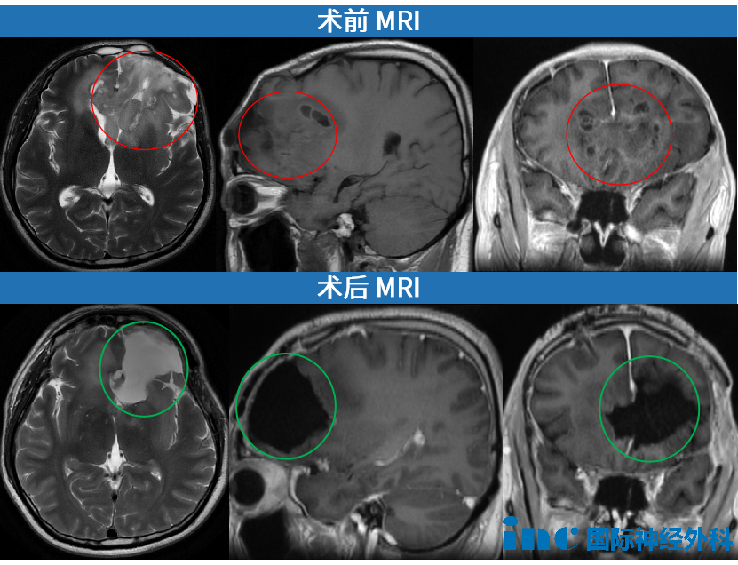 術(shù)前術(shù)后MRI