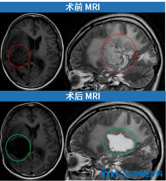 術(shù)前術(shù)后MRI